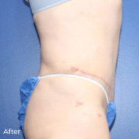 Abdominoplasty