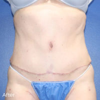 Abdominoplasty