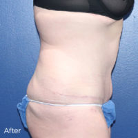 Abdominoplasty