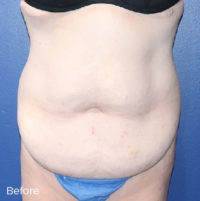 Abdominoplasty