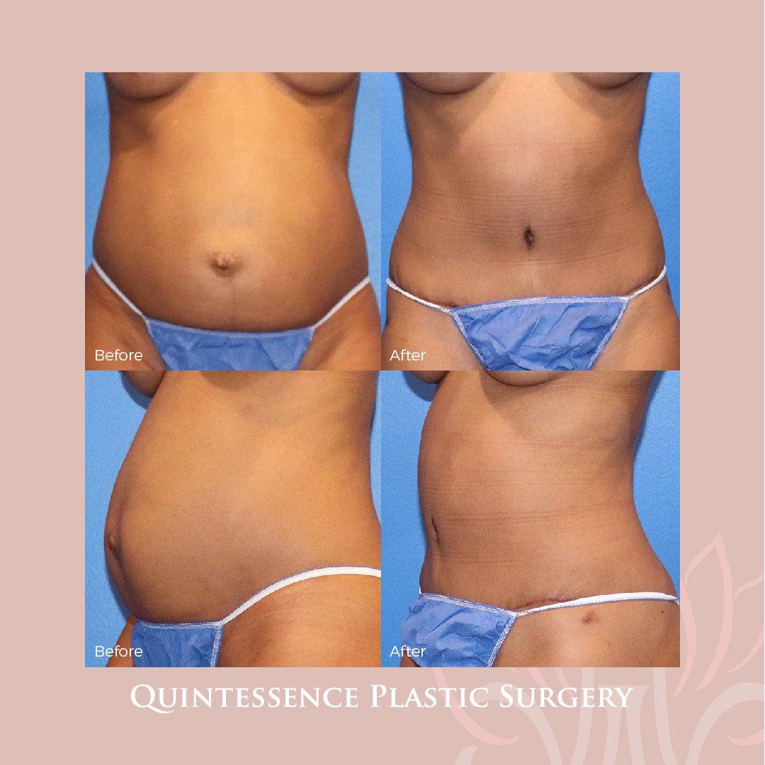 Abdominoplasty Surgery Results Austin
