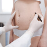 mommy makeover results and recovery process