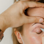 Blepharoplasty